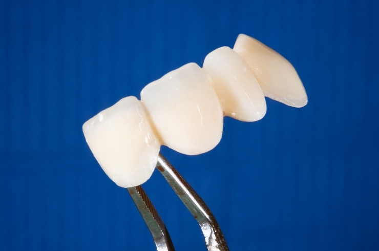 Dental Crowns