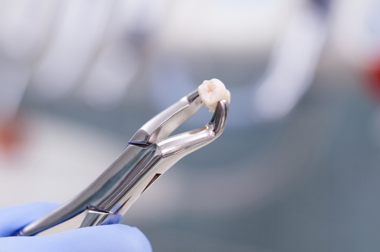 Tooth Extraction